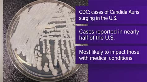 Candida auris: Drug-resistant fungus spreading in US, CDC says | kens5.com