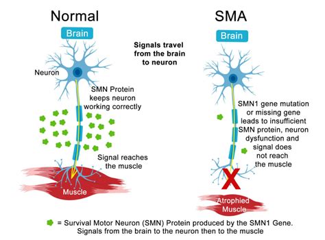 Spinal Muscular Atrophy (SMA): Types, Causes, Symptoms and Treatment