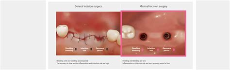 Future is Here: “Digital Implants” What, Why and How?