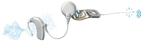 Understanding Hearing Loss | Advanced Bionics