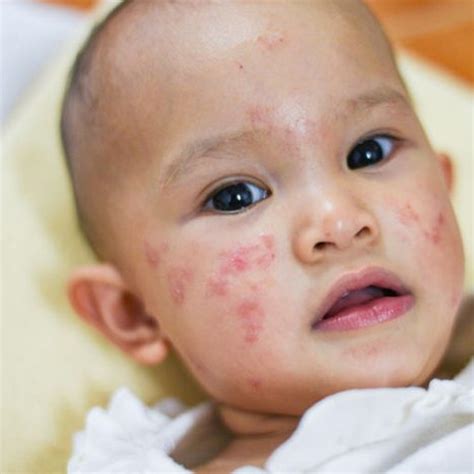 Prevalence and Impact of Skin Disorders in Pediatric Populations