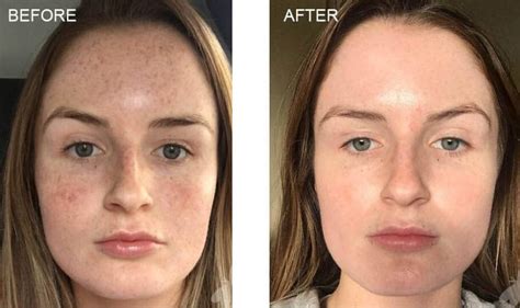 https://images.squarespace-cdn.com/content/v1/54f4d255e4b08fac2ceb414b/1627599777817-TWKTKH10CZKPP733MLPP/chemical-peel-before-after.jpg