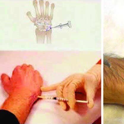 Injection Types 的图像结果