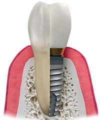 Dental Implant In Delhi| Get Best Dental Implants At Affordable Prices