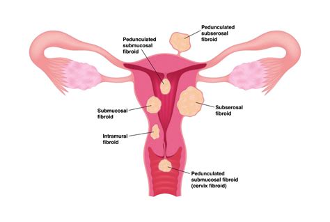 What Does Fibroid Pain Feel Like? | Fibroid Institute Texas