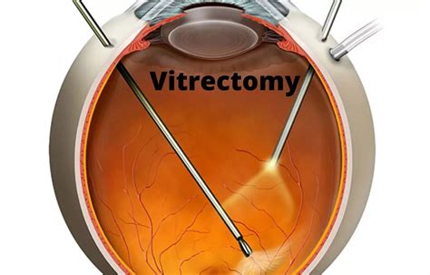 Pars plana vitrectomy improves retinal reattachment but not visual ...