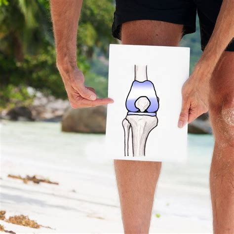 Living With Arthritis - Is Knee Replacement A Solution? - HealthFinder