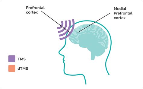 Deep Transcranial Magnetic Stimulation | dTMS Therapy