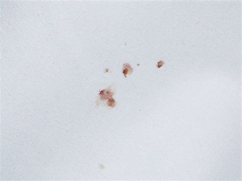 Do Bed Bug Bites Hurt? (Pain Guide) - PestSeek