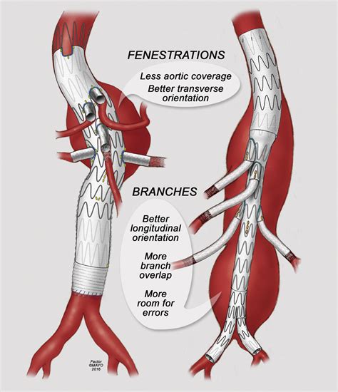 Endovascular repair of thoracoabdominal aortic aneurysms using fenestrated and branched ...