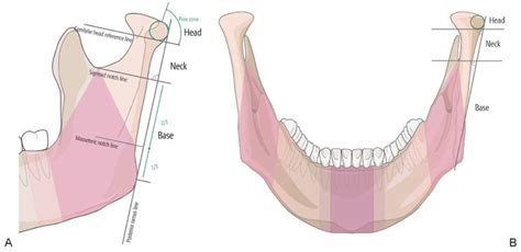 The Comprehensive AOCMF Classification System: Condylar Process ...