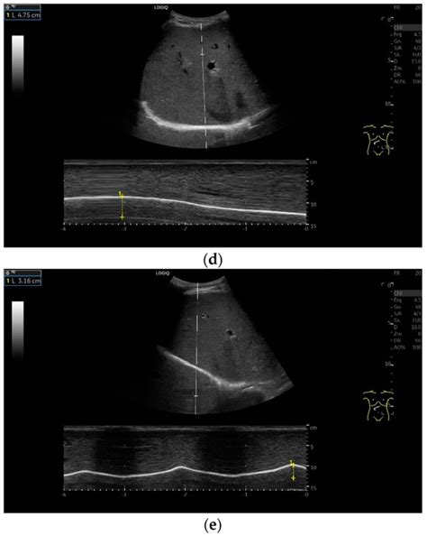 The Perception of the Diaphragm with Ultrasound: Always There Yet ...