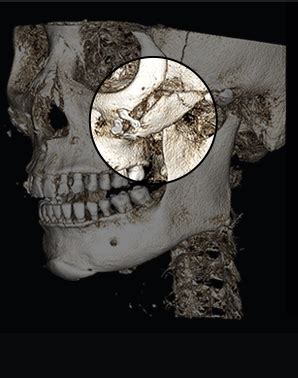 Image result for Cheekbones Reduction Book