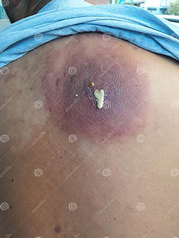 Image result for Giant Abscess Exploding On Back