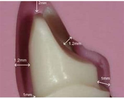 Nerve Block Injection 的图像结果