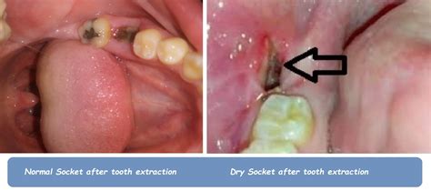 Tooth Socket After Extraction 的图像结果