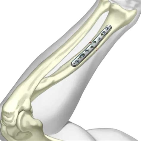 Best Forearm Plating Surgery in India | Healic Orthopedics