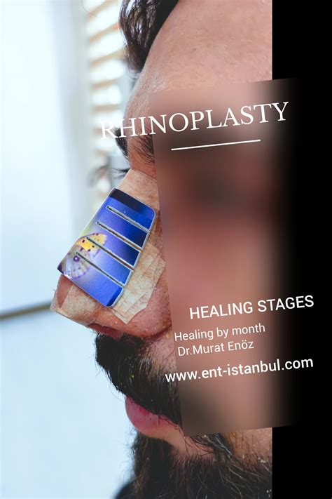 Rhinoplasty Recovery Guide 👃 - 30 - Total Healing Time After Rhinoplasty