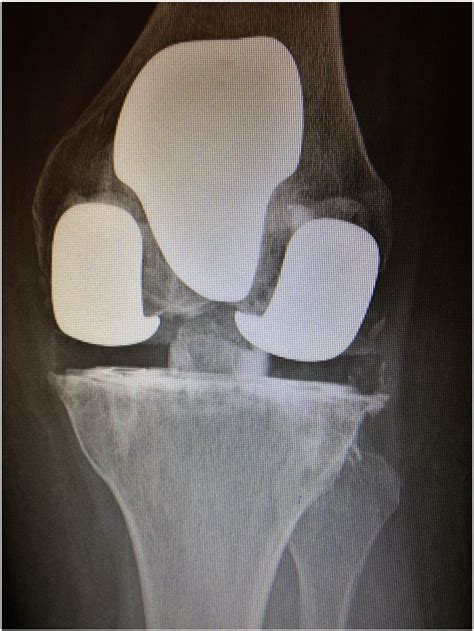 Tricompartmental Degenerative Arthrosis
