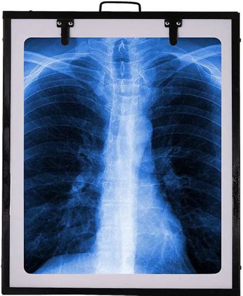 saniquick Xray view Box Digital for Clinic LED Premium Single Film with ...
