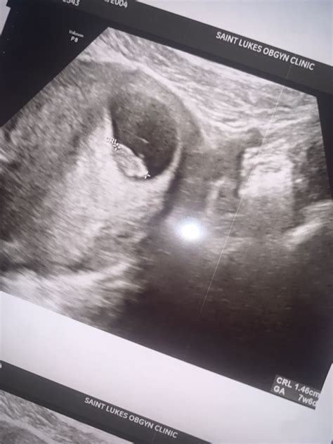 8 Week Ultrasound 2022