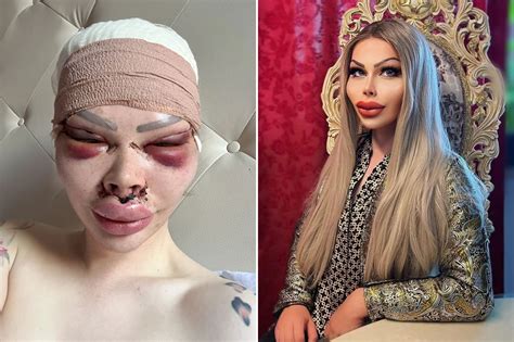 Blue Face Barbie Before Surgery