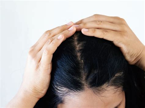 Scalp Dandruff 的图像结果