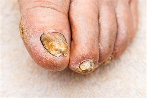 फंगल इंफेक्शन होने पर नाखूनों की देखभाल कैसे करें? | Nail Care Tips ...