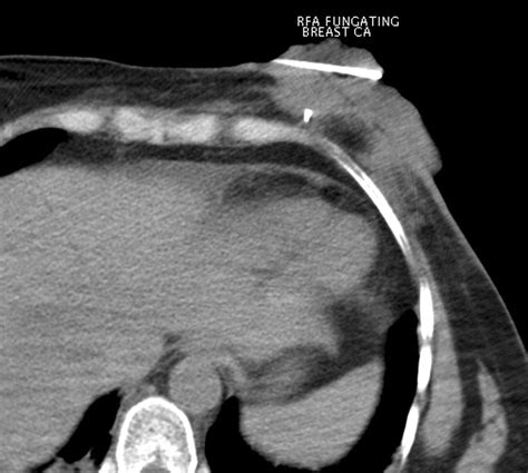Palliative Radiofrequency Ablation of a Fungating, Symptomatic Breast Lesion | AJR
