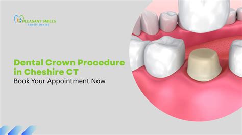 Dental Crown Procedure in Cheshire, CT: Pleasant Smiles