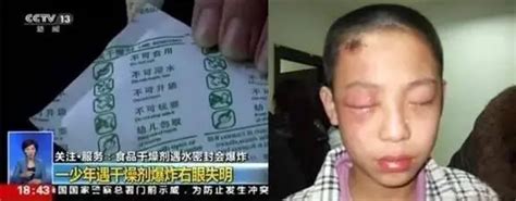 8岁男孩眼球被“融” 终身失明 原因竟是零食里的食品干燥剂 ＊ 阿波罗新闻网