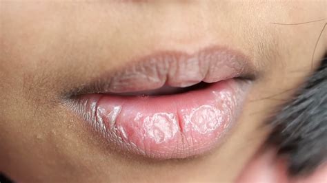 Chapped Lips Pregnancy Sign at Crystal Frasher blog