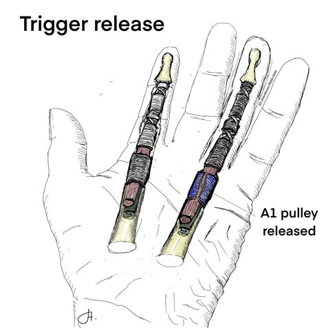 Lightshow Trigger Finger at Phyllis Mosier blog