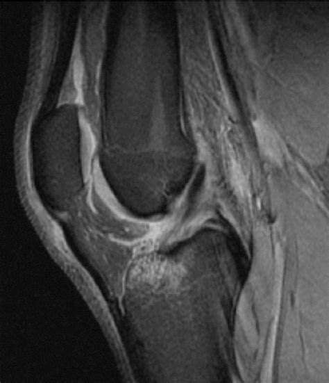 Figure 7 from MRI Evaluation of Internal derangement of the Knee Joint ...
