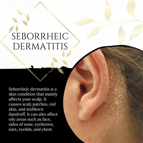 Seborrheic dermatitis ear treatment fundamentals – Artofit
