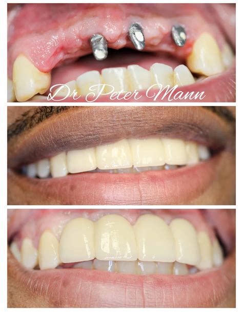 Dental Implants Before And After Photos | NYC Dentist