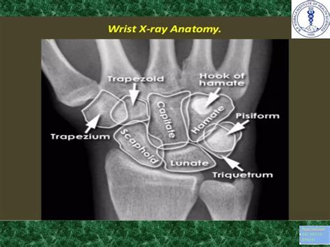 Anatomy and imaging of wrist joint (MRI AND XRAY) | PPTX