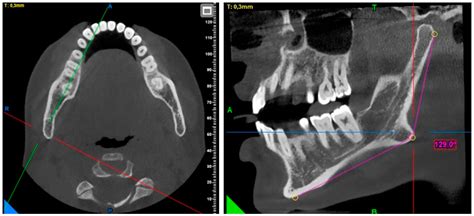 A Morphometric Evaluation of the Mandibular Condyle, Coronoid Process ...