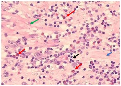 IL-5 Serum and Appendicular Lavage Fluid Concentrations Correlate with ...