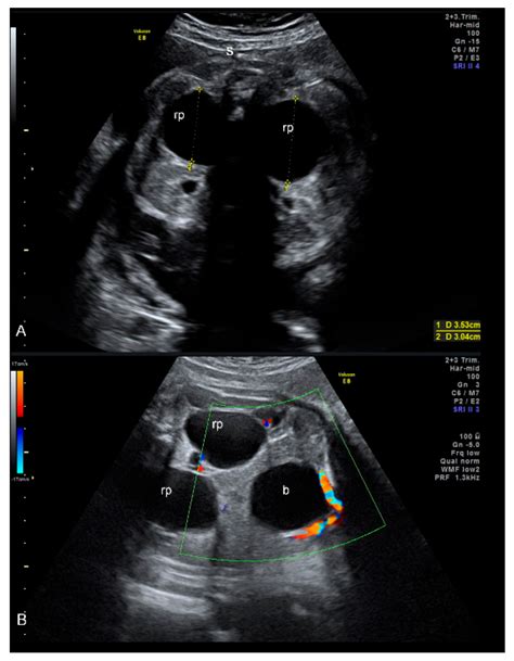 Prenatal Diagnosis of Severe Fetal Hydronephrosis Due to Pyeloureteral Junction Syndrome with ...