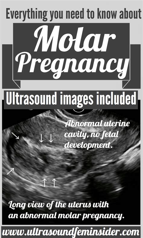 Molar pregnancy information. Ultrasound included. - Ultrasoundfeminsider