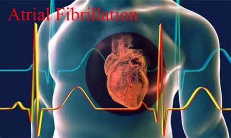 DAPT has less bleeding risk than triple therapy in patients with AF ...