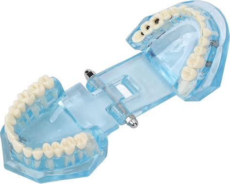 Dental Pathology Teaching Model Transparent Model Of Mandibular Tooth ...