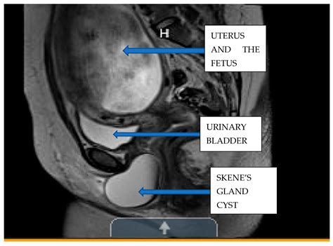 Symptomatic Giant Skene’s Gland Cyst During Second Trimester Pregnancy ...