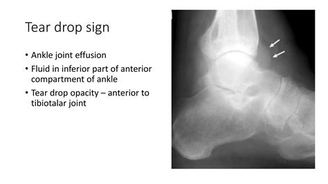 Ankle & Foot Xray & Surgical Approaches | PPTX