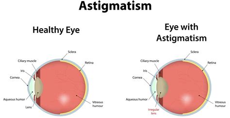 Is Astigmatism Genetic