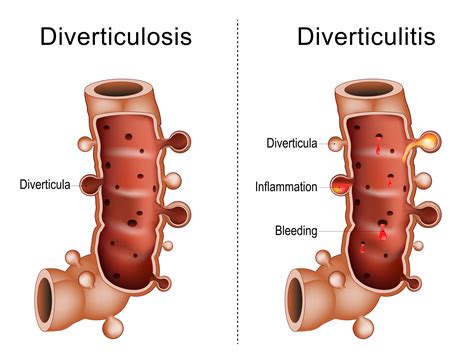 Diverticulosis | Guía de salud | Vidaliax