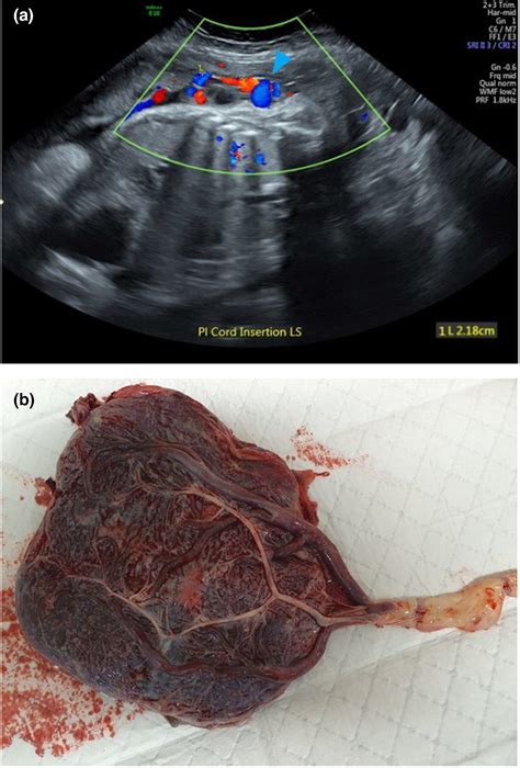 Current practice of placental cord insertion documentation in Australia ...