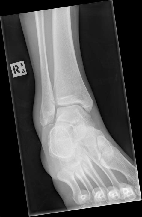 Ankle lateral malleolus avulsion fracture with os subfibulare | Image ...