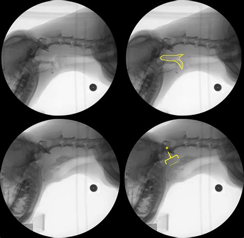 Standardization of a Videofluoroscopic Swallow Study Protocol to ...
